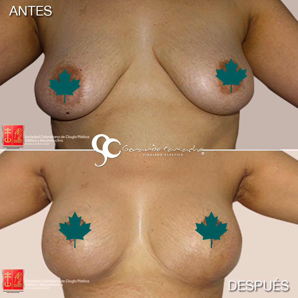 Mamoplastia de Reduccion